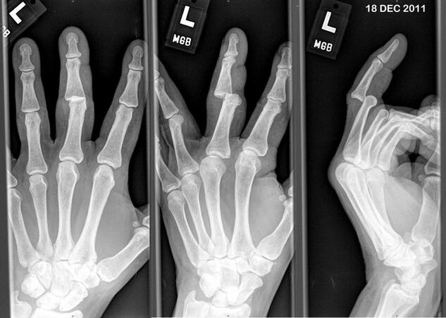 X-ray of sprained fingers