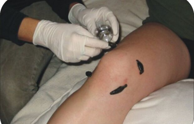 Placing leeches on an inflamed knee joint
