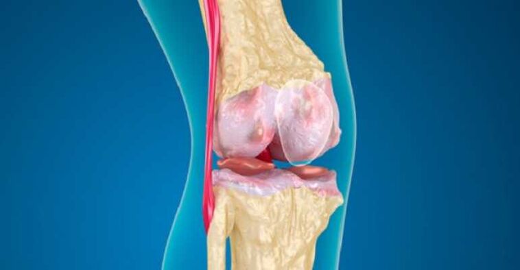 Arthrosis of the knee joint disease that causes the cartilage to be destroyed in the joints