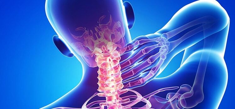 osteochondrosis of the cervical vertebrae