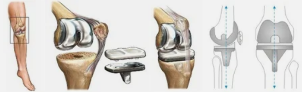Arthroplasty of the knee example