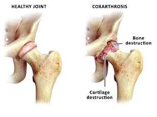 in comparison, healthy joints and hip zustavas